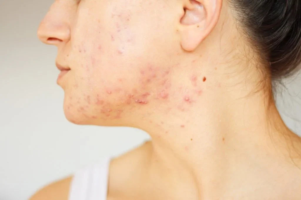 Hudpleierutine for deg som går på isotretinoin