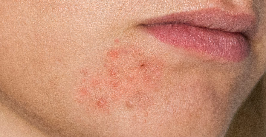 Hva er perioral dermatitt?