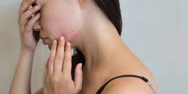 Hudpleie ved bruk av isotretinoin – slik tar du vare på huden din under behandling