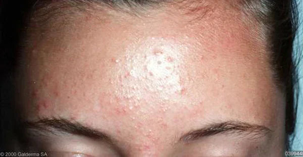 Hva er fungal acne?