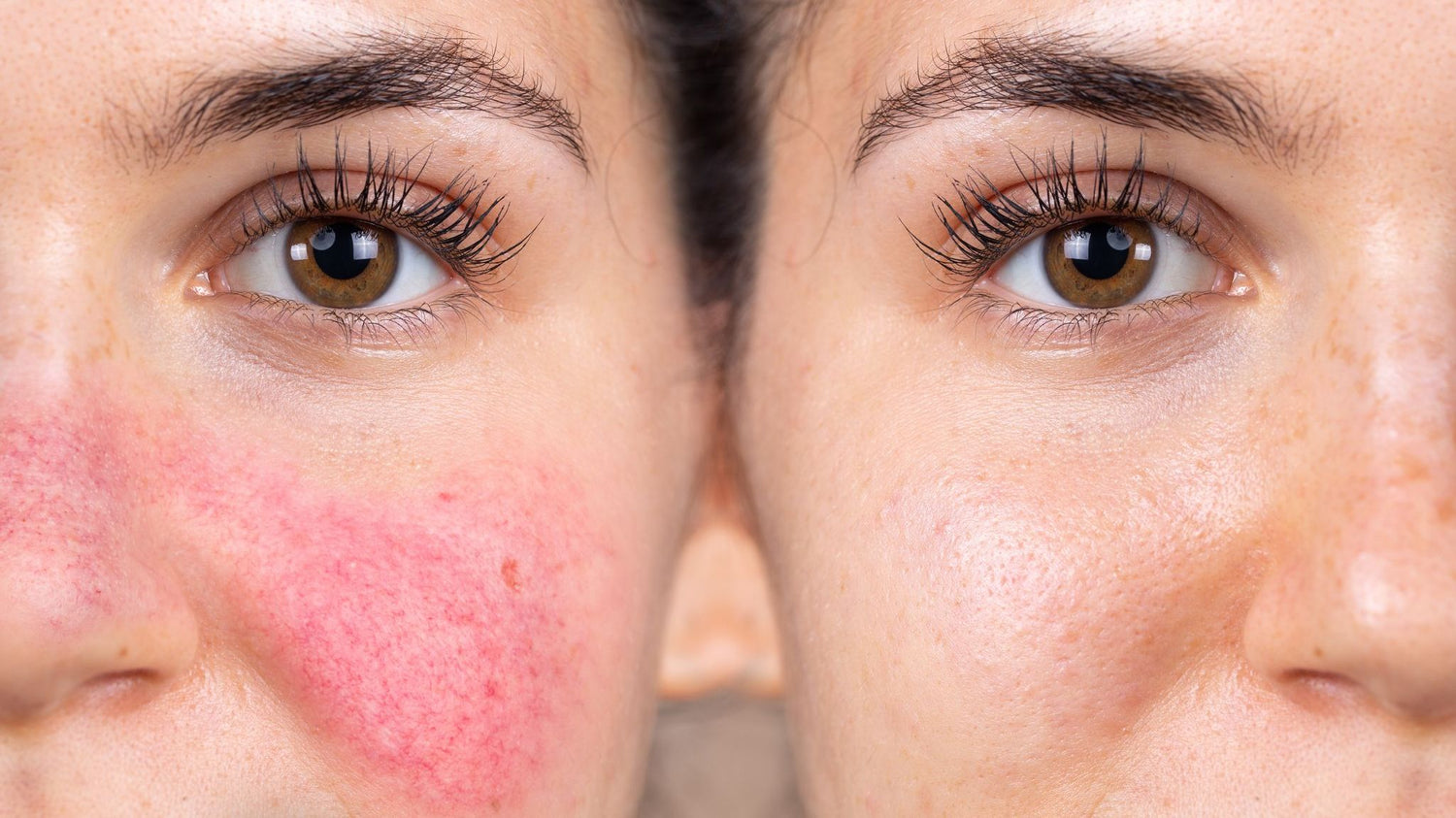 Behandlinger mot rosacea