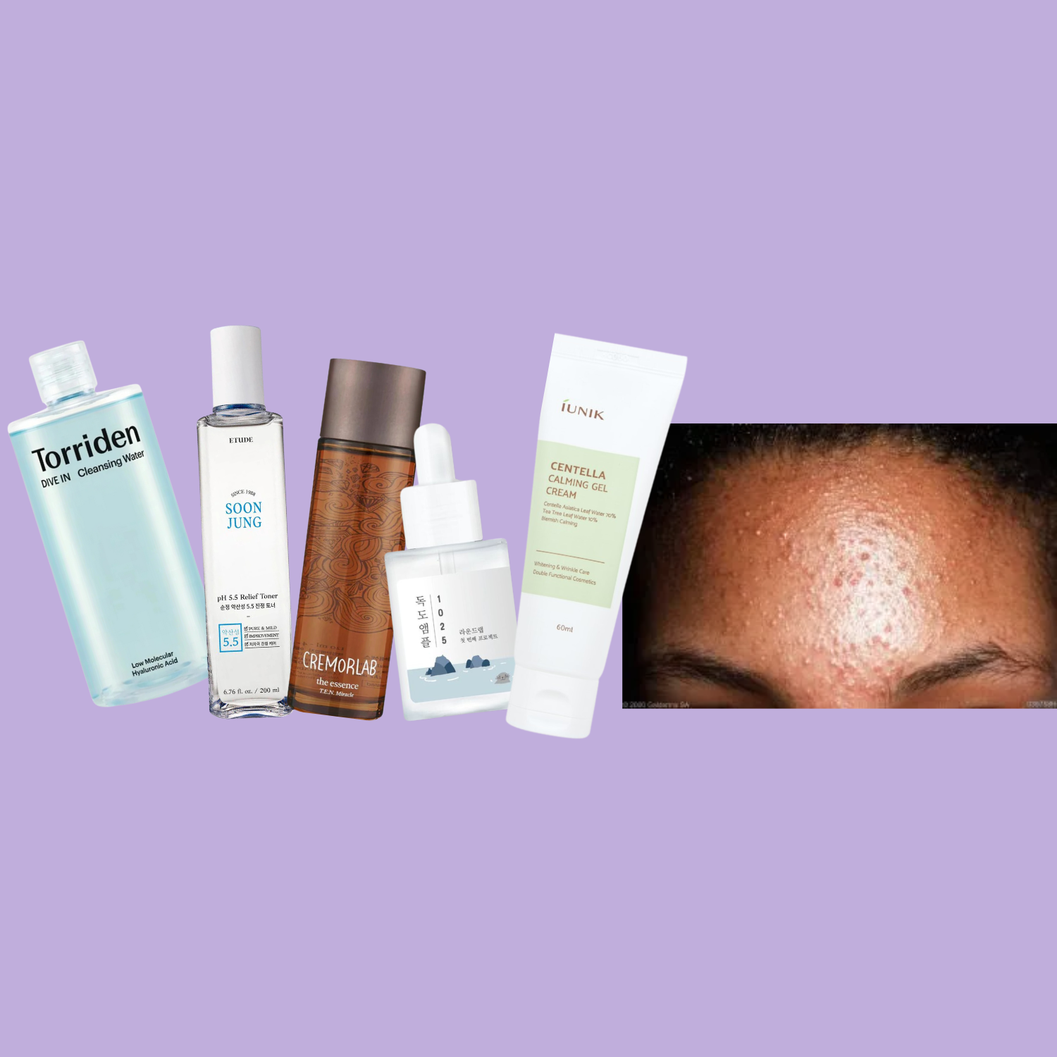Trygge hudpleieprodukter ved fungal acne