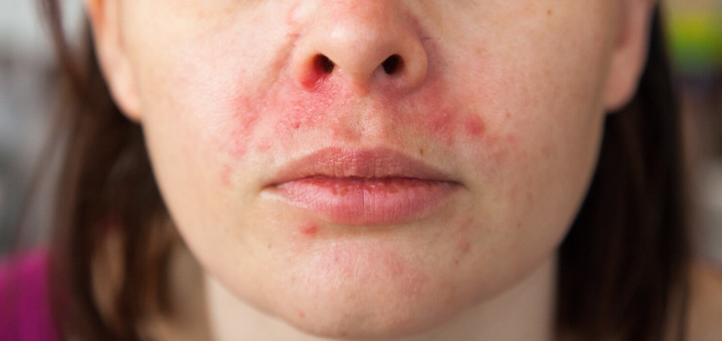 Hudpleieprodukter ved perorial dermatitt