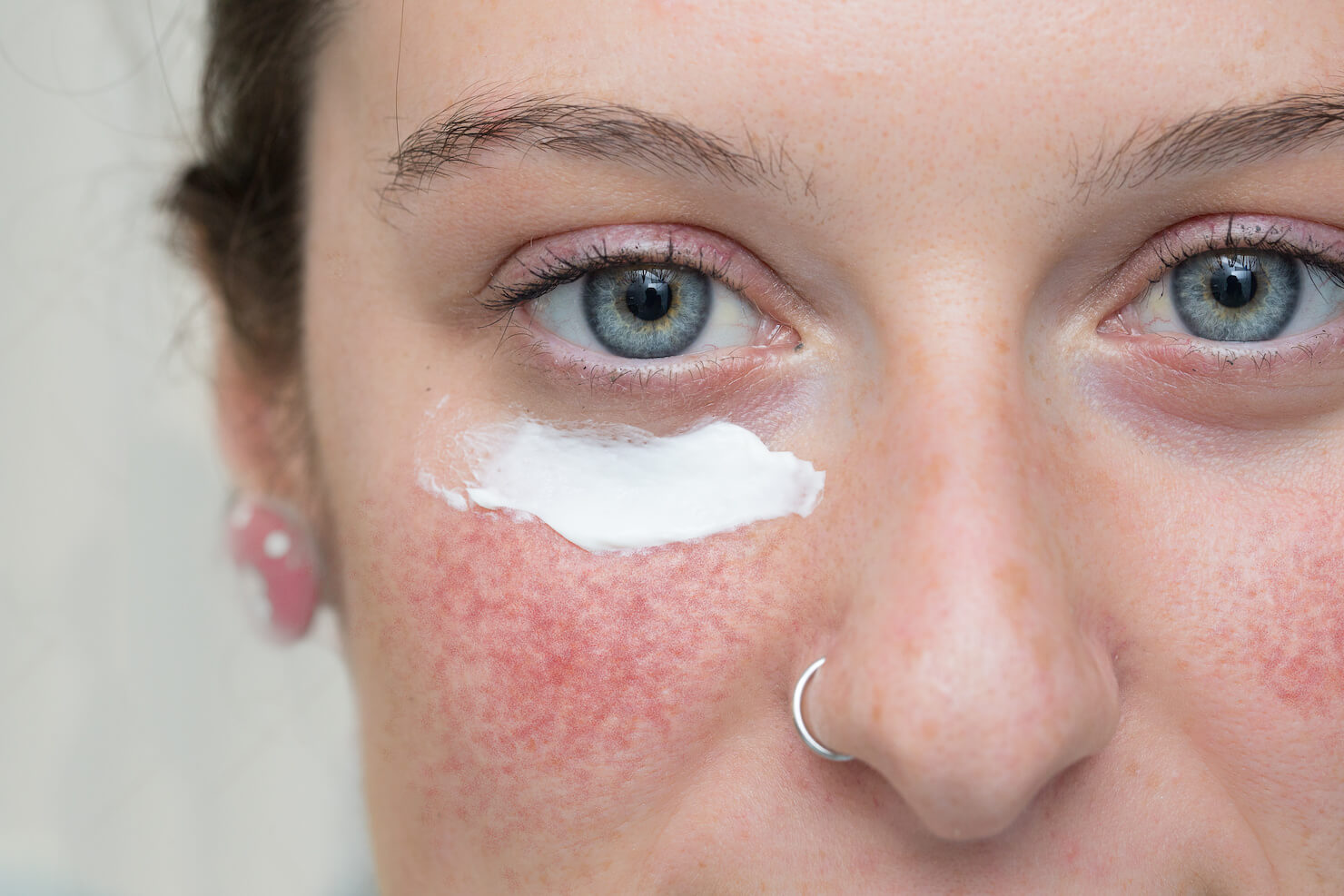 Hudpleietips for personer med rosacea